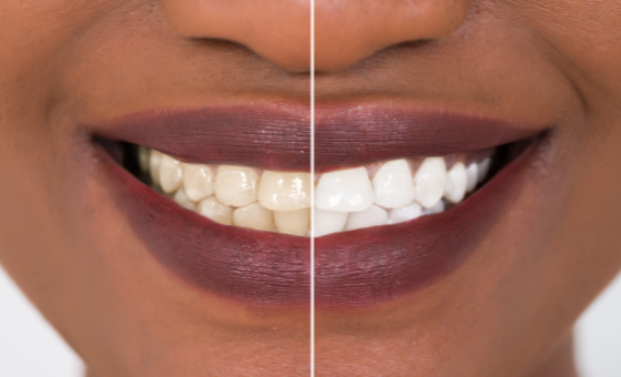 teeth whitening in cape town