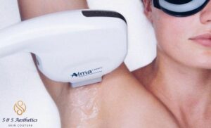 hair removal treatment Cape Town