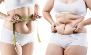Non-surgical Liposuction at a low cost