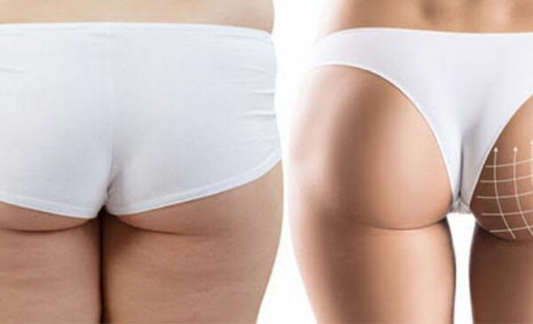 A Breast Lift Treatment or Butt Lift in Bothasig