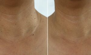 A Skin Tag Removal in Blouberg (5)