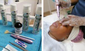 A Chemical Peel and Microneedling Combo in Randburg