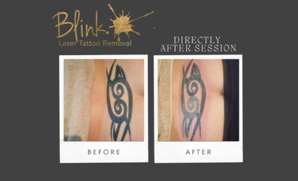 A Laser Tattoo Removal Session in Claremont
