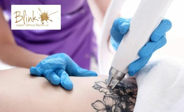A Laser Tattoo Removal Session in Claremont