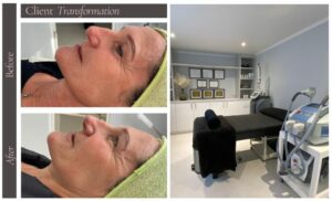 A CO2 Fractional Laser Resurfacing in Table View
