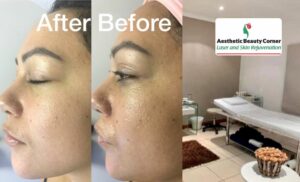 A collage of a treatment area at Aesthetic Beauty Corner in Lone Hill and a woman's skin before and after a chemical peel done at Aesthetic Beauty Corner