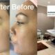 A collage of a treatment area at Aesthetic Beauty Corner in Lone Hill and a woman's skin before and after a chemical peel done at Aesthetic Beauty Corner