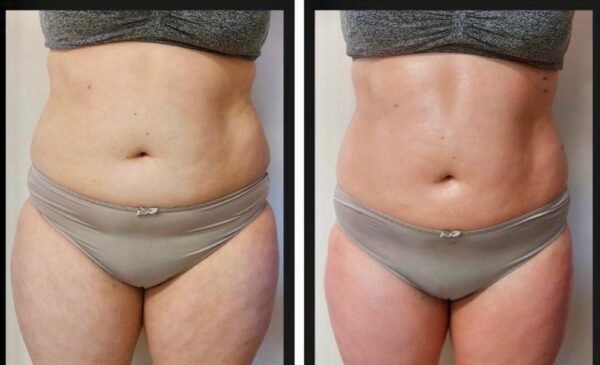 A before and after photo of Laser Lipo Slimming treatment done at Exquisite Laser and Aesthetics in Umhlanga Ridge