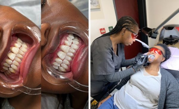 A woman having a teeth-whitening session done at Dermaskin Aesthetics in Fourways