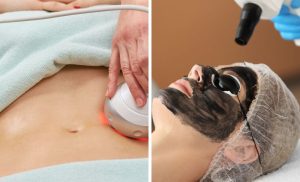 A Collage of someone getting a Black Doll Carbon Laser treatment and a Tummy RF treatment at Mode Hair and Beauty in Umhlanga.