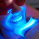 Get A Teeth Whitening Treatment in Sea Point