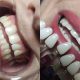 A before and after photo of a woman having a dental-grade teeth-whitening session at Bella Donna Beauty & Aesthetics Studio in Edenvale,