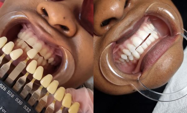 A before and after photo of a woman having a dental-grade teeth-whitening session at Bella Donna Beauty & Aesthetics Studio in Edenvale