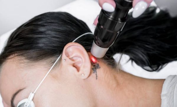 A stock photo of a woman undergoing laser tattoo removal