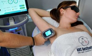 An Underarm Laser Hair Removal Session in Claremont
