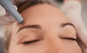 Microneedling and a Facial in Claremont