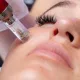 microneedling