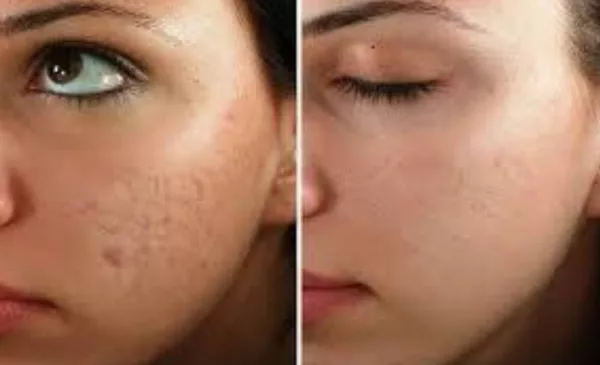 microneedling