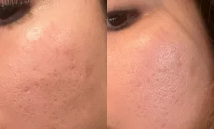 microneedling