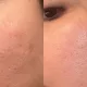 microneedling