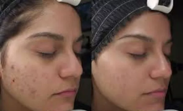 chemical peel