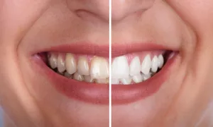 Teeth Whitening